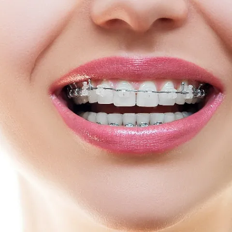 ワイヤー矯正｜中野区の大人の矯正歯科は東中野矯正歯科