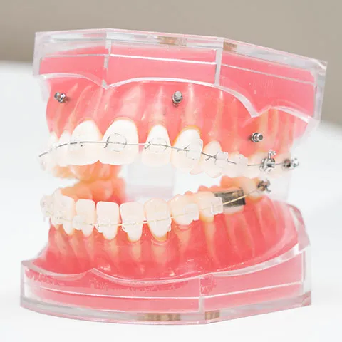 セラミックブラケット｜中野区の大人の矯正歯科は東中野矯正歯科