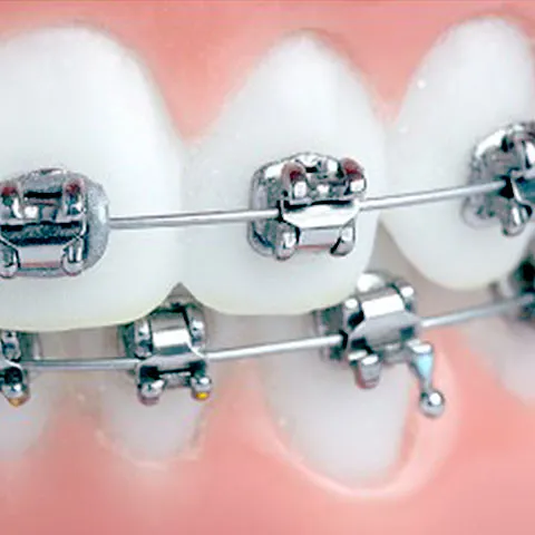 部分矯正｜中野区の大人の矯正歯科は東中野矯正歯科